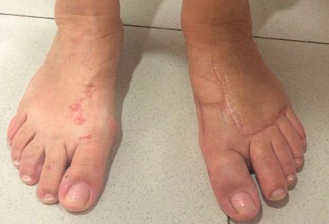 Cirugia de juanetes con tornillos
