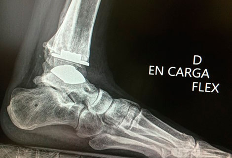 lesión osteocondral de la cúpula talar síntomas de diabetes